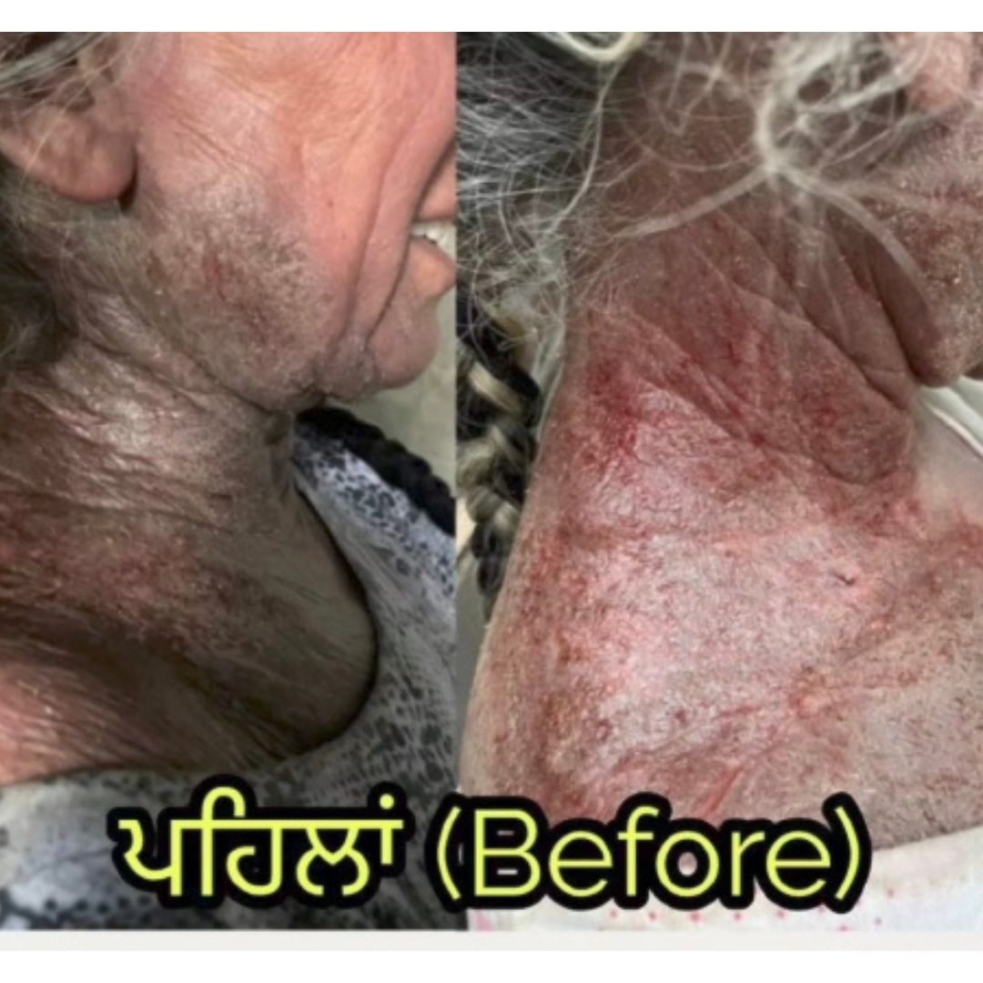 Acne/Pigmentation: before