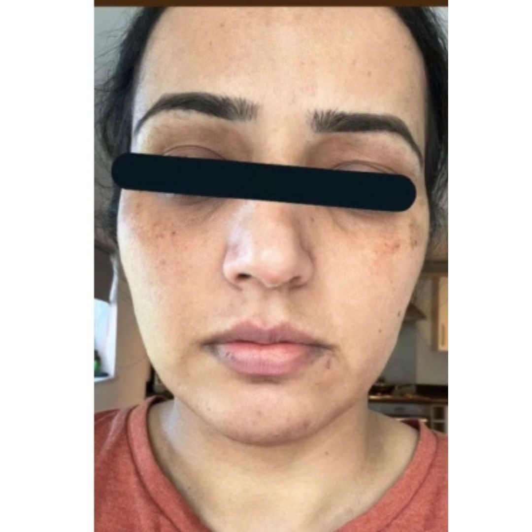 Acne/Pigmentation: before