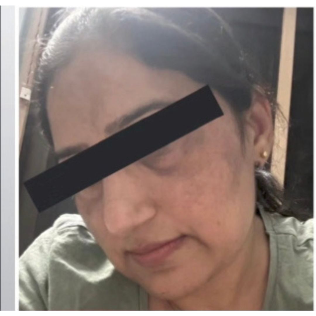 Acne/Pigmentation: before