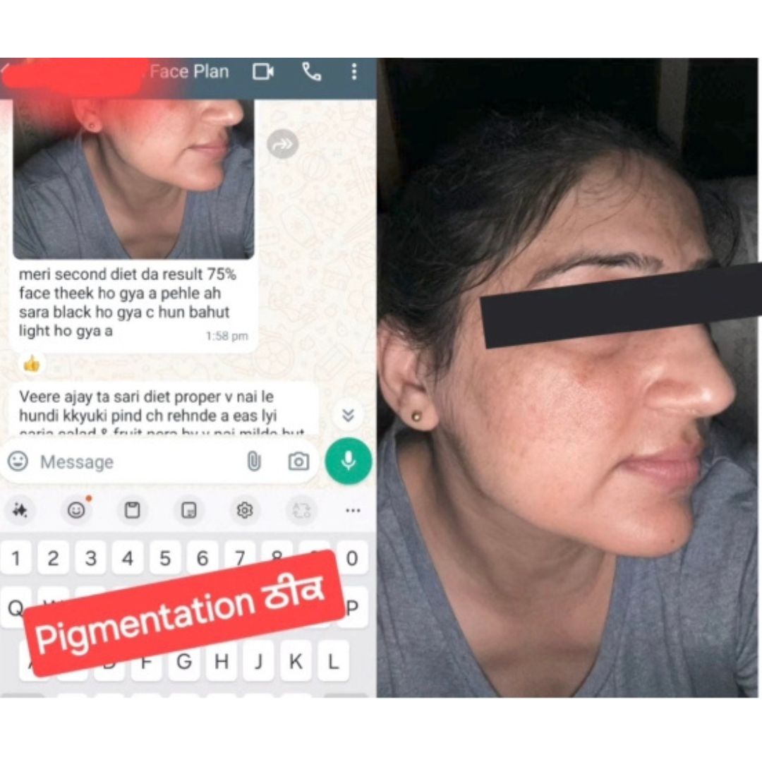 Acne/Pigmentation: after
