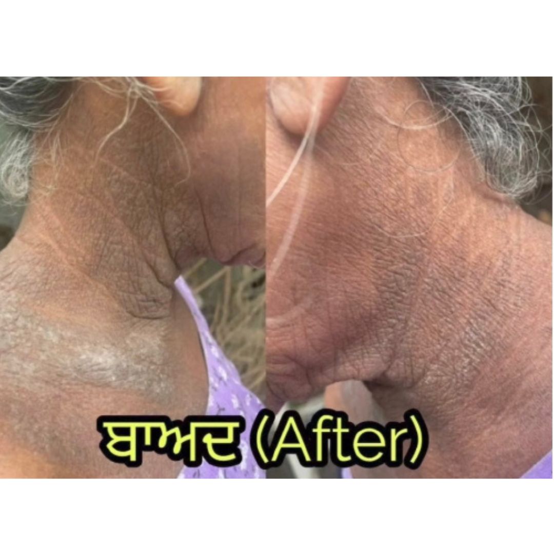 Acne/Pigmentation: after