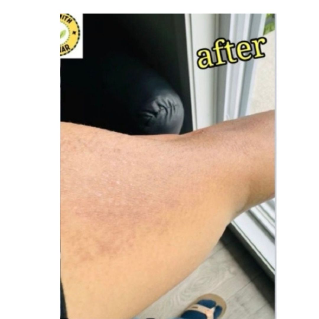 Acne/Pigmentation: after