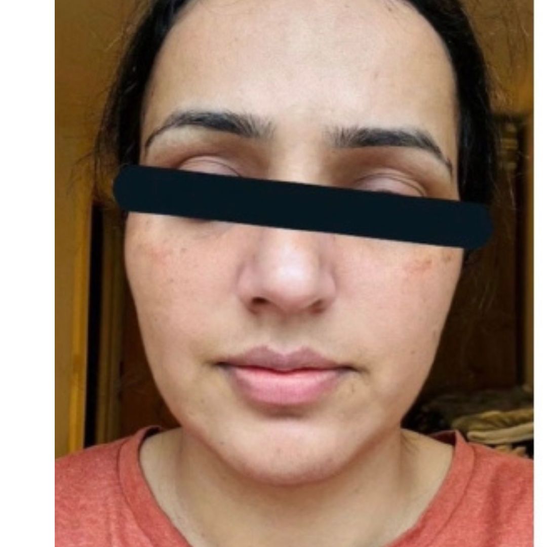 Acne/Pigmentation: after