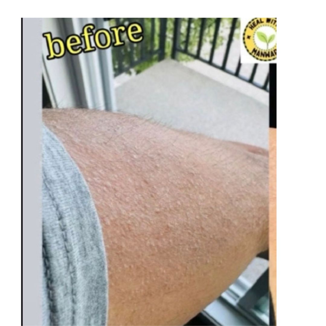 Acne/Pigmentation: before